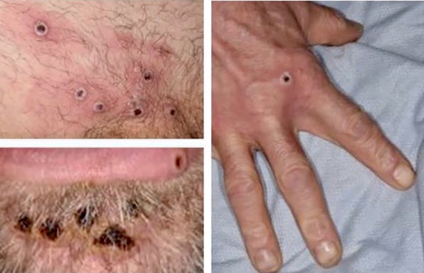 2 lagi kes baharu cacar monyet