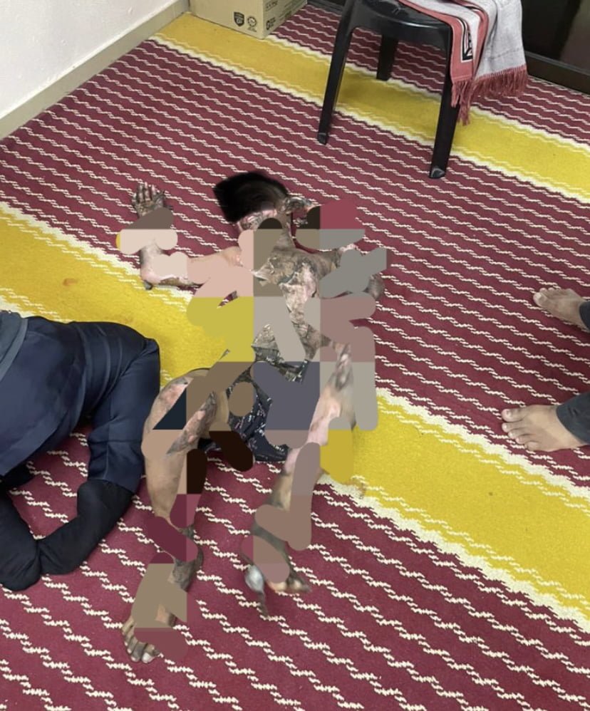 Cuba ambil bola di bilik janakuasa TNB, kanak-kanak 12 tahun melecur seluruh badan