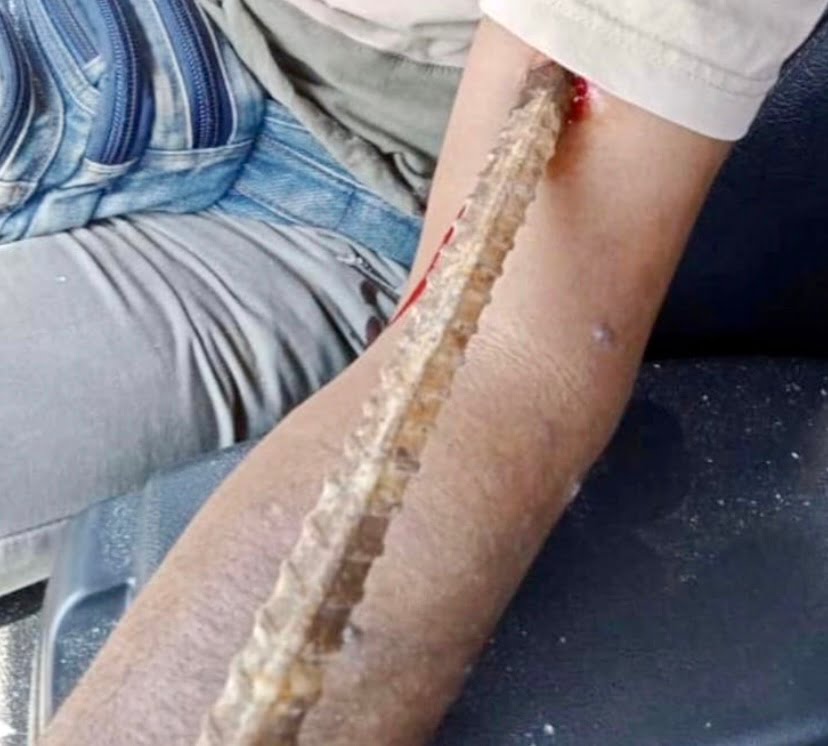 Lelaki nyaris maut tubuh tertusuk besi