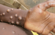 Malaysia kesan 31 kes disyaki mpox, 25 disah negatif