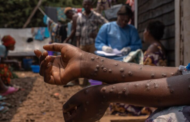 Mpox boleh merebak melalui sentuhan – KKM