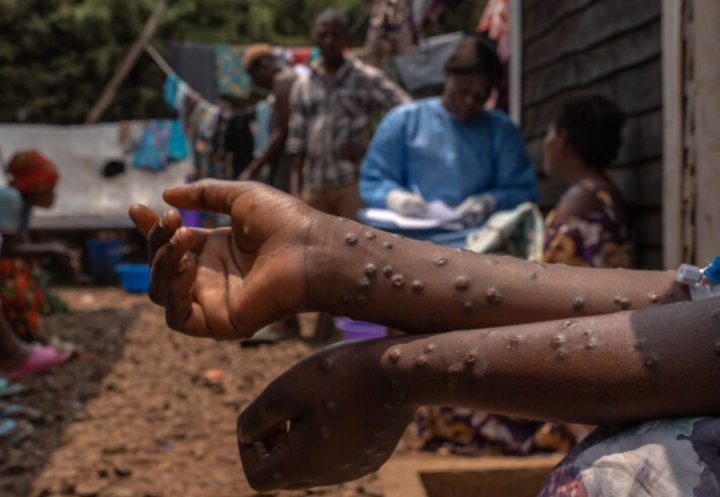 Mpox boleh merebak melalui sentuhan – KKM