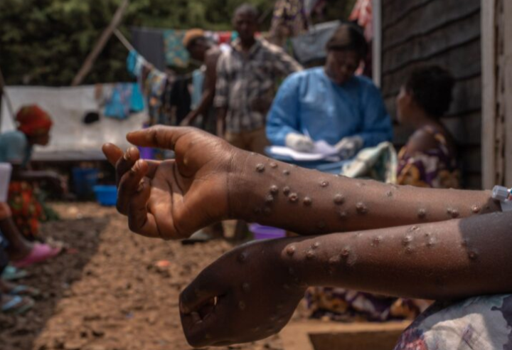 Kes pertama libatkan varian mpox baharu di Britain