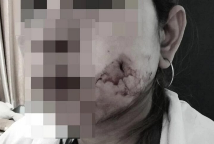Wanita Bangkok alami pendarahan selepas bedah lesung pipit