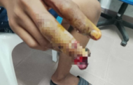 Remaja putus sebahagian jari tengah angkara mercun