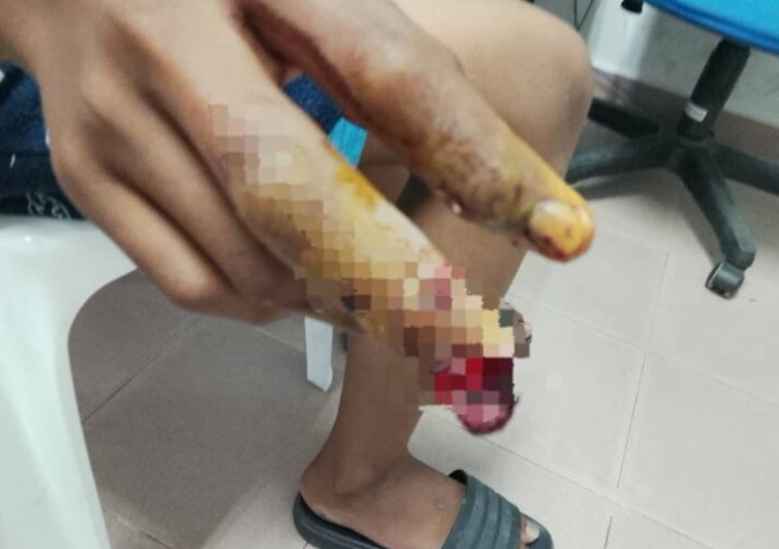 Remaja putus sebahagian jari tengah angkara mercun