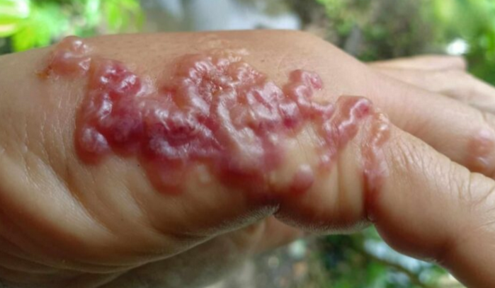 Lelaki dijangkiti larva cacing kulit selepas cabut rumput
