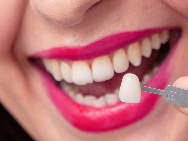 Wanita AS ditahan selepas guna ‘super glue’ pasang veneer gigi pesakit