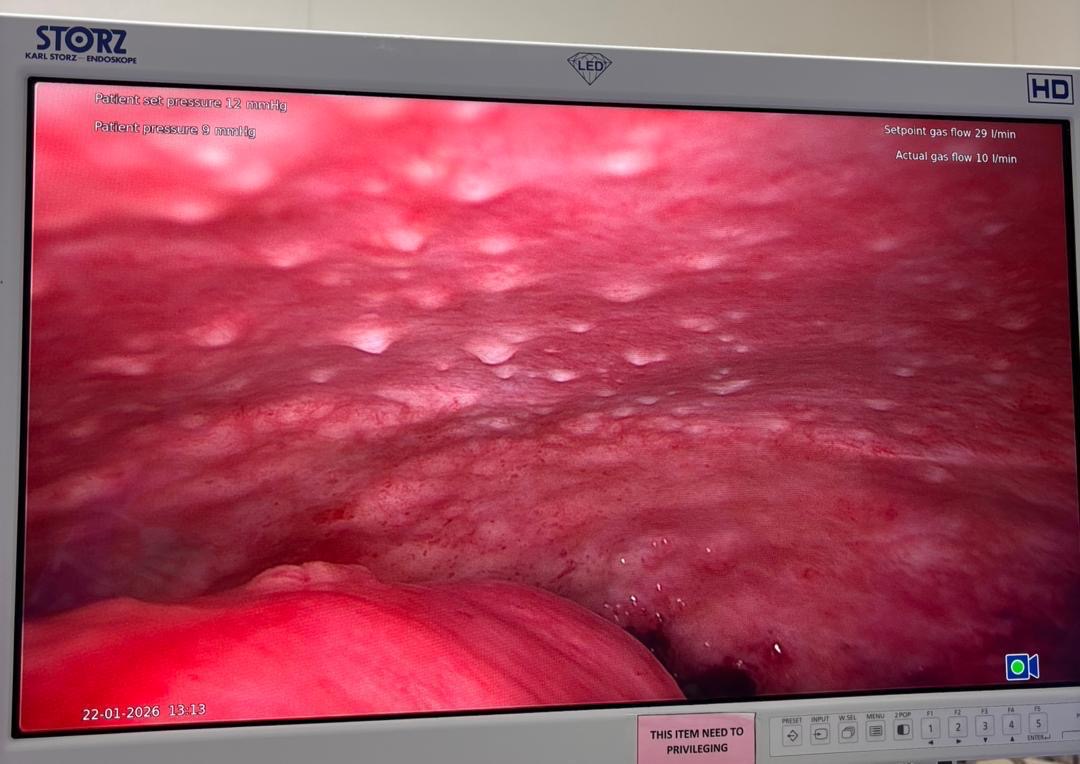 Kanser kolorektal sering dikesan lewat